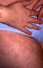 toxocariasis_clinical_appearence_1.jpg