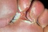 нога_Athlete-s-foot-962826.jpg